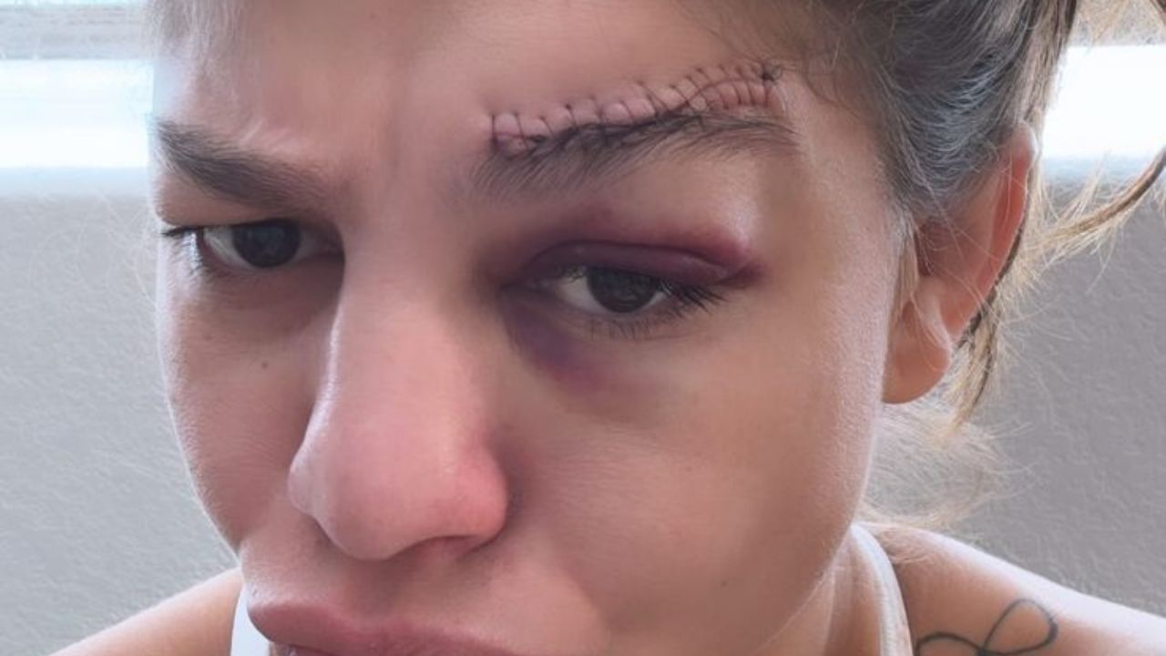 Mayra Sheetara exibe pontos no supercílio. Foto: Reprodução/Instagram