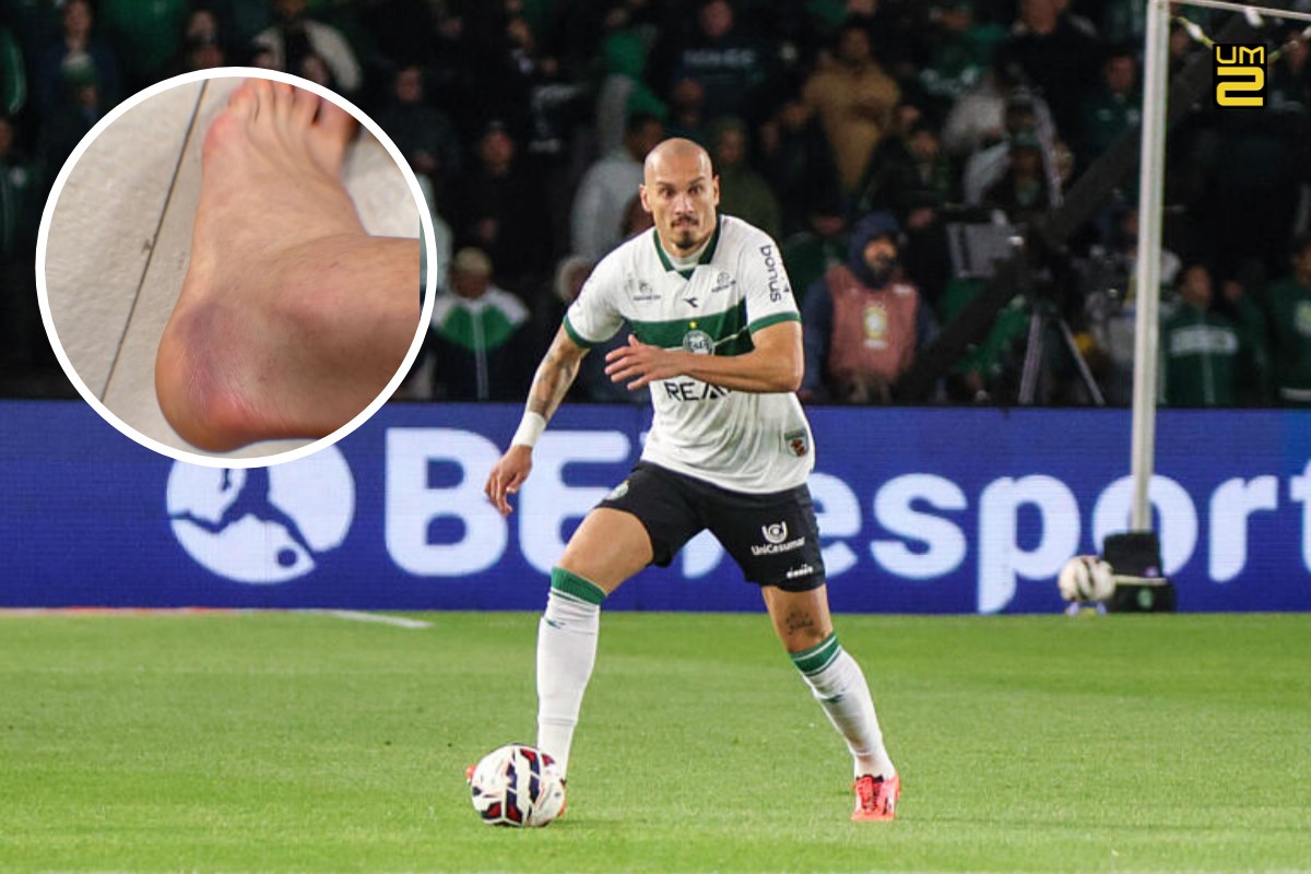 Atletiba: Zagueiro do Coritiba revela pé machucado após lance polêmico