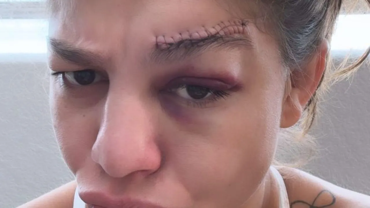 Mayra Sheetara exibe pontos no supercílio. Foto: Reprodução/Instagram