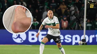 Atletiba: Zagueiro do Coritiba revela pé machucado após lance polêmico